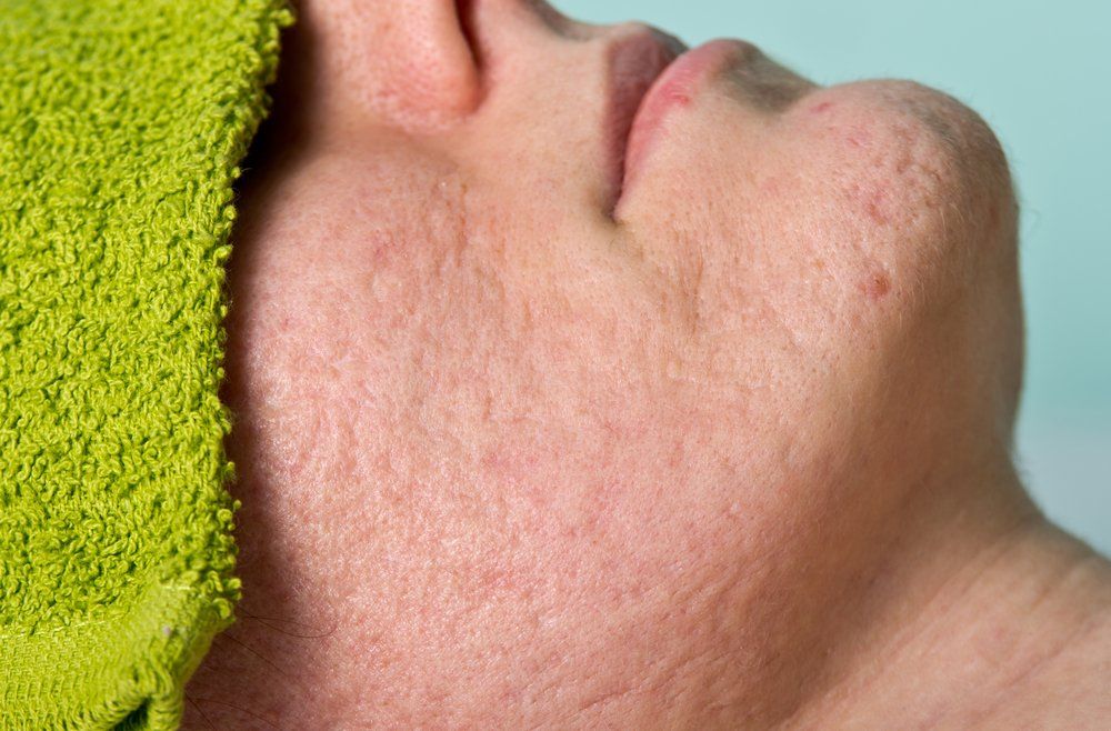 pitted acne scar treatment