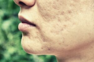 pitted acne scars